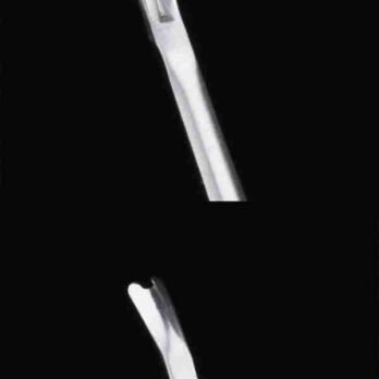 不鏽鋼死皮叉3